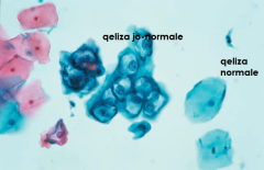Pap Testi - Dallohen qelizat jo-normale në qendër dhe dy qeliza normale në të djathtë.
