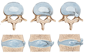 hernia e dikut intervertebror - hernia diskale, nucleus pulposus, anulus fibrosus